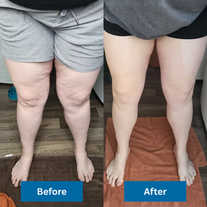 Fevon LegFlow Pro™ Compression System